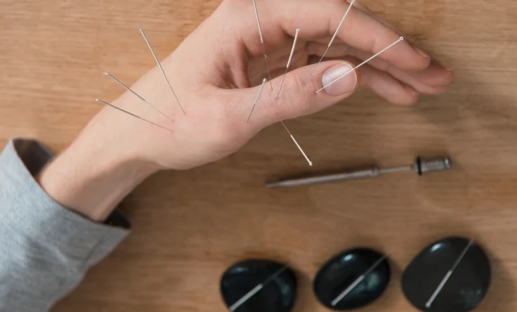 Acupuncture